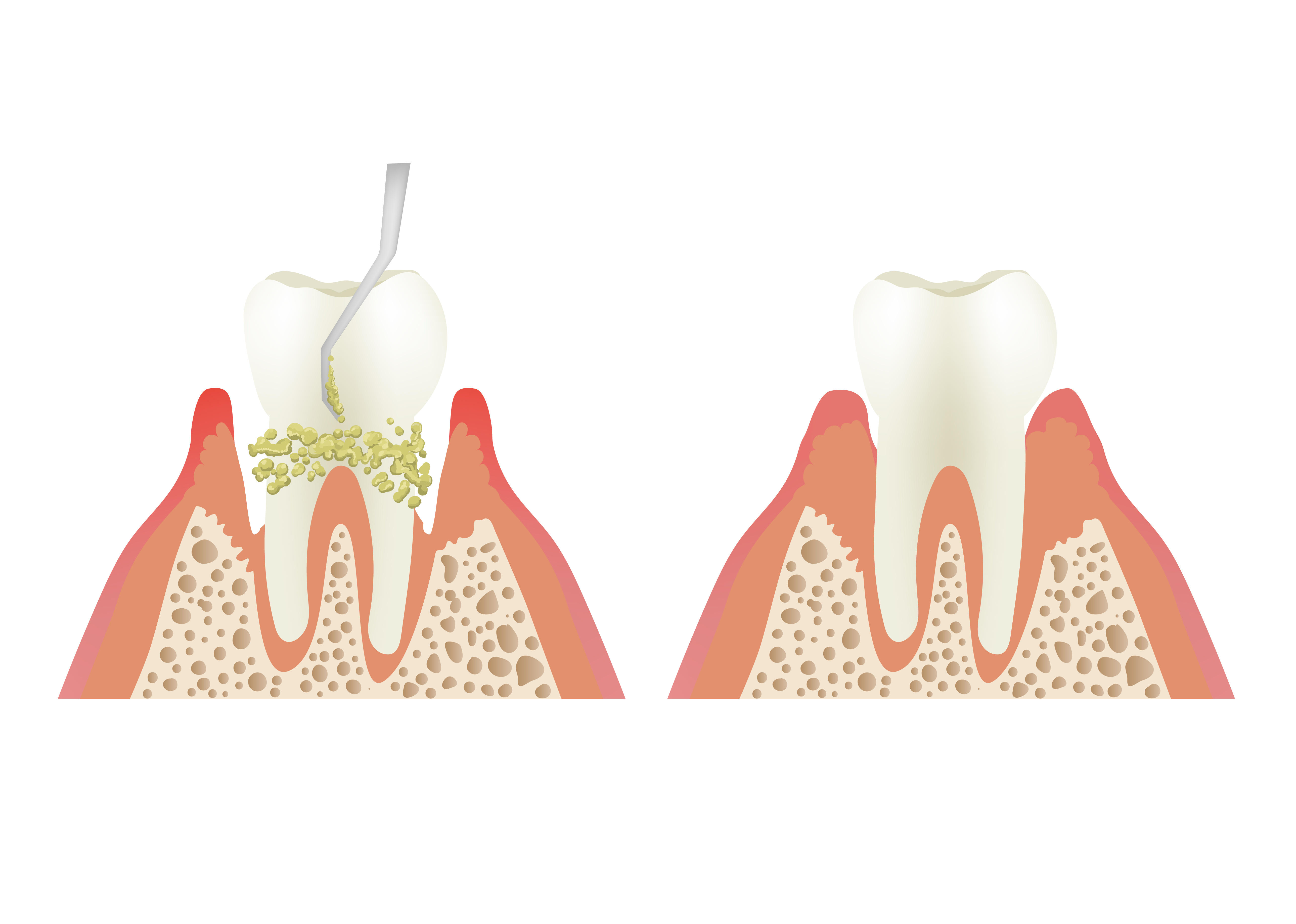 Should I Get Root Planing and Scaling (“deep cleaning”) from the General  Dentist or Periodontist?: Willow Glen Dental Specialists: Periodontists