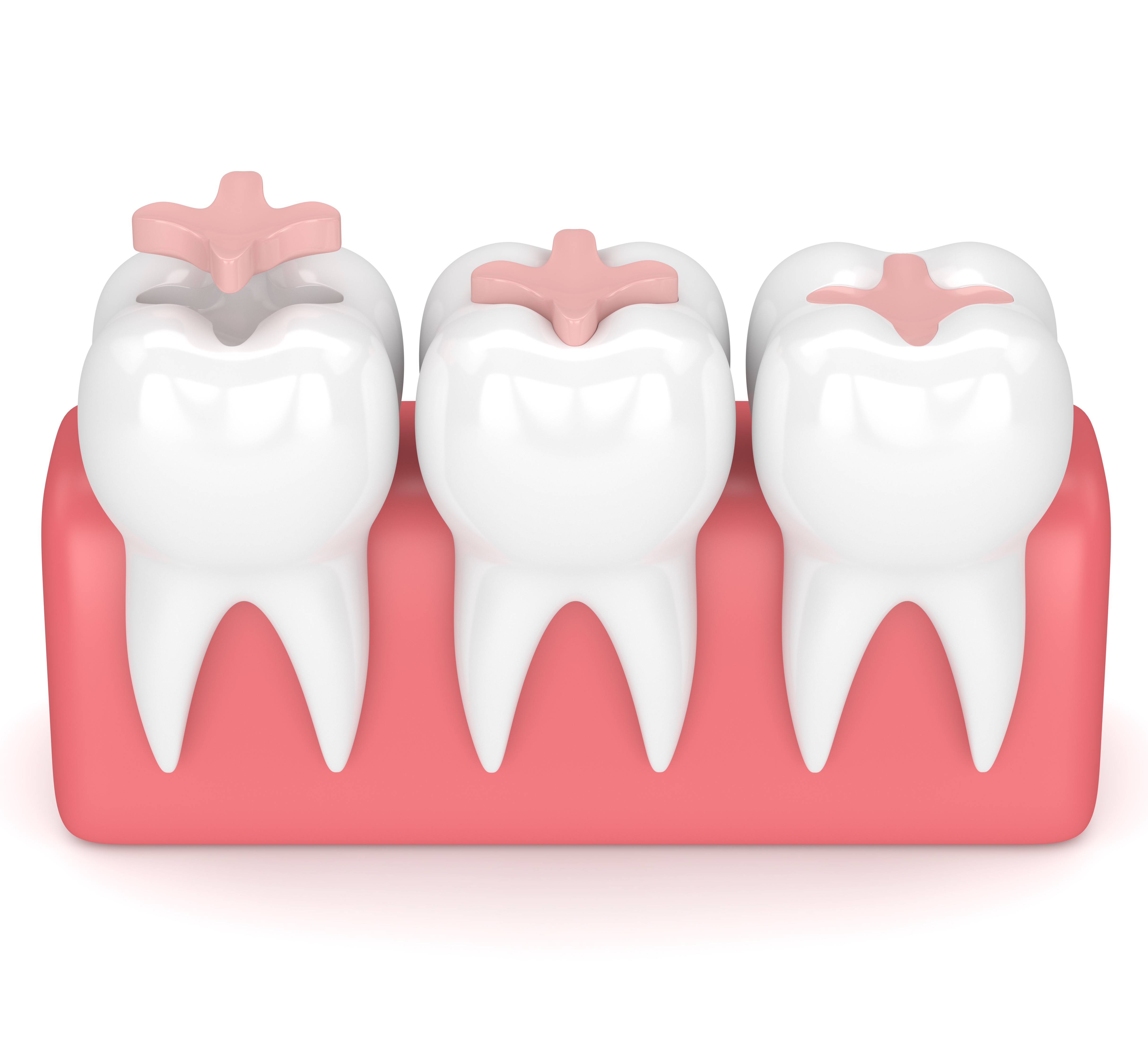 dental fillings