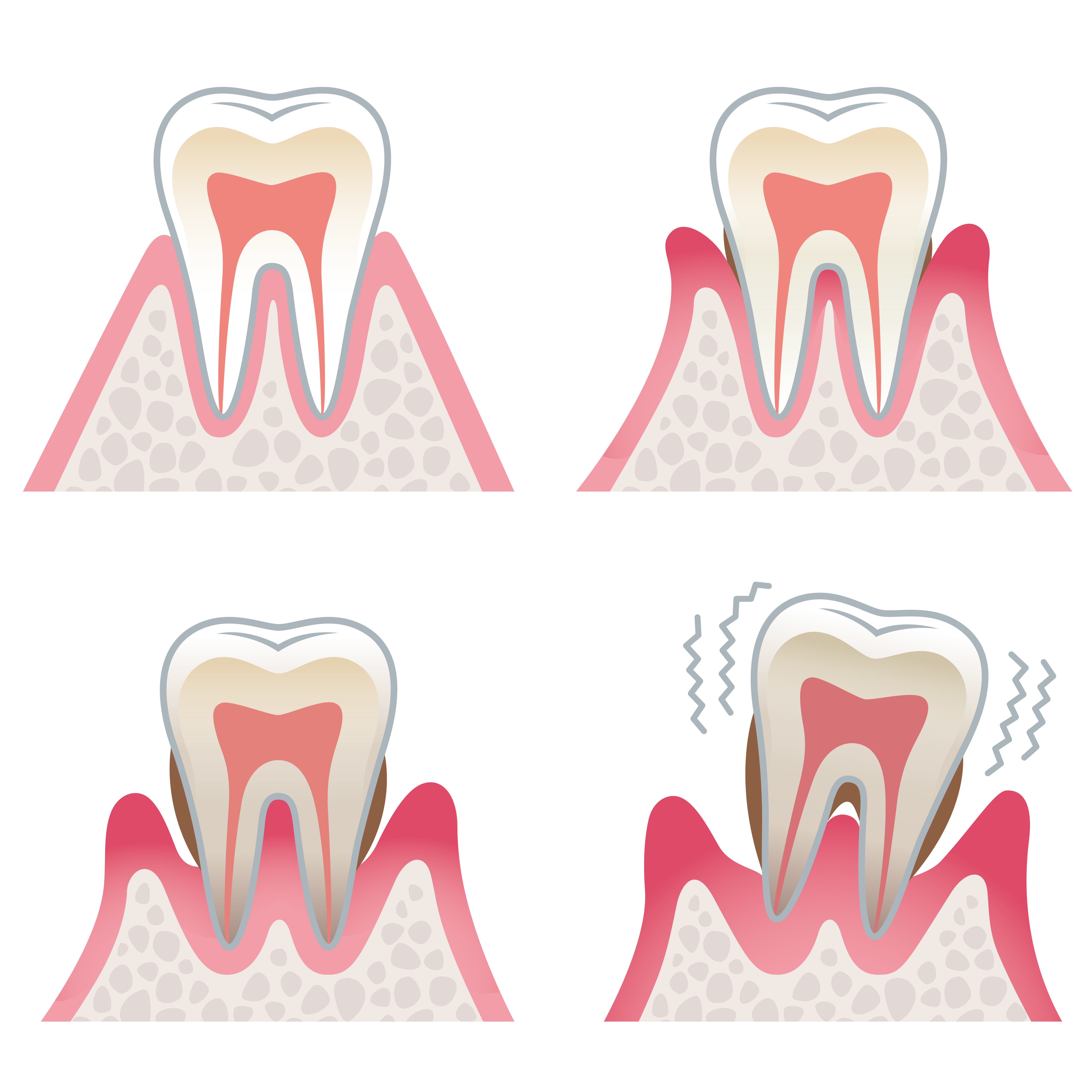 Symptoms of Gum Disease